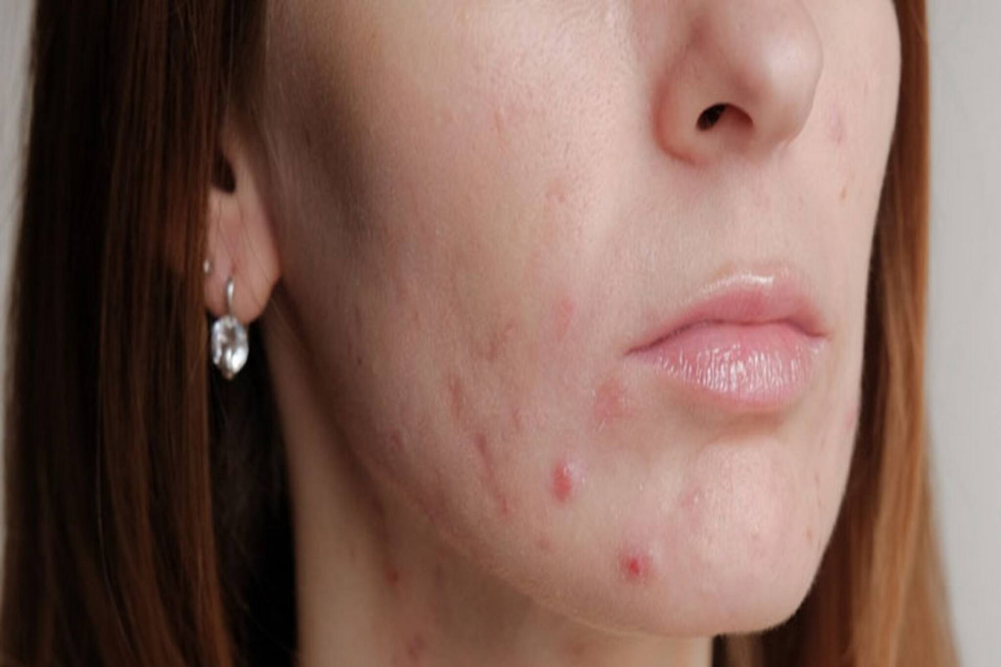 ব্রণ নিয়ে নাজেহাল? আপনার বালিশের ওয়ার বদলাতে হবে, জানুন