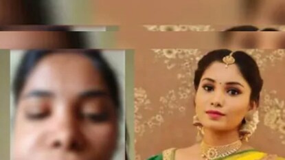 রুট ক্যানাল করার ফলে স্বাতীর মুখের ডান দিক সম্পূর্ণ ফুলে গিয়ে বিকট আকার ধারণ করেছিল রুট ক্যানাল করার ফলে স্বাতীর মুখের ডান দিক সম্পূর্ণ ফুলে গিয়ে বিকট আকার ধারণ করেছিল