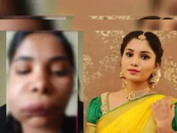 রুট ক্যানাল করার ফলে স্বাতীর মুখের ডান দিক সম্পূর্ণ ফুলে গিয়ে বিকট আকার ধারণ করেছিল