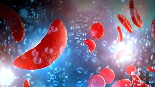World Sickle Cell Disease Day: Experts recommend increasing awareness on SCD in the state