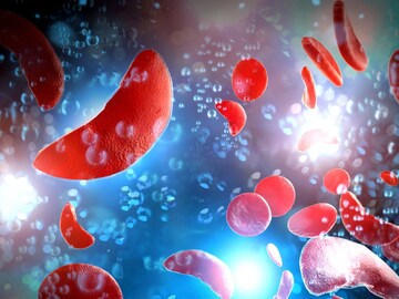 World Sickle Cell Disease Day: Experts recommend increasing awareness on SCD in the state