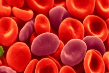 সময়ে চিকিৎসা না হলে জীবনের বিরাট ঝুঁকি! Sickle Cell আসলে থাবা বসাচ্ছে না তো?