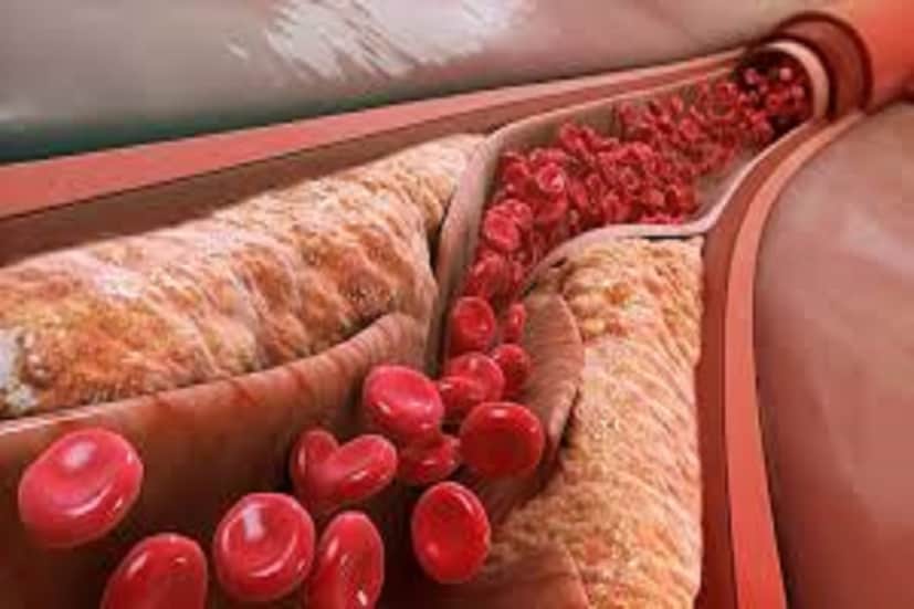 হাই ব্লাডপ্রেশার (High Blood Pressure), হার্ট অ্যাটাক (Heart Attack), করোনারি আটারি ডিজিজ (Coronary Artery Disease) বা ট্রিপিল ভেসেল ডিজিজ (Triple Vessel Disease)-এ ধরনের রোগের ফলে সমস্যা হতে পারে ৷ প্রতীকী ছবি ৷