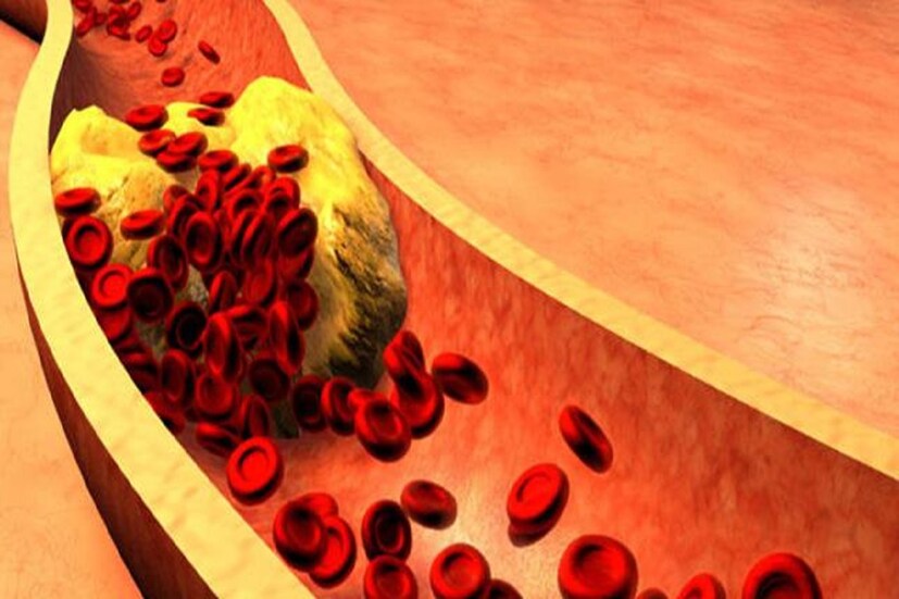 কোলেস্টেরল (Cholesterol) বাড়লে খাবারের ক্ষেত্রে রাশ টানতে হয় ৷ কোনও রকমের অবহেলা করলেই পড়তে হবে সমস্যায় ৷ একই সঙ্গে ধূমপান (Smoking) ও মদ্যপান করা থেকে বিরত থাকতে হবে ৷ প্রতীকী ছবি ৷