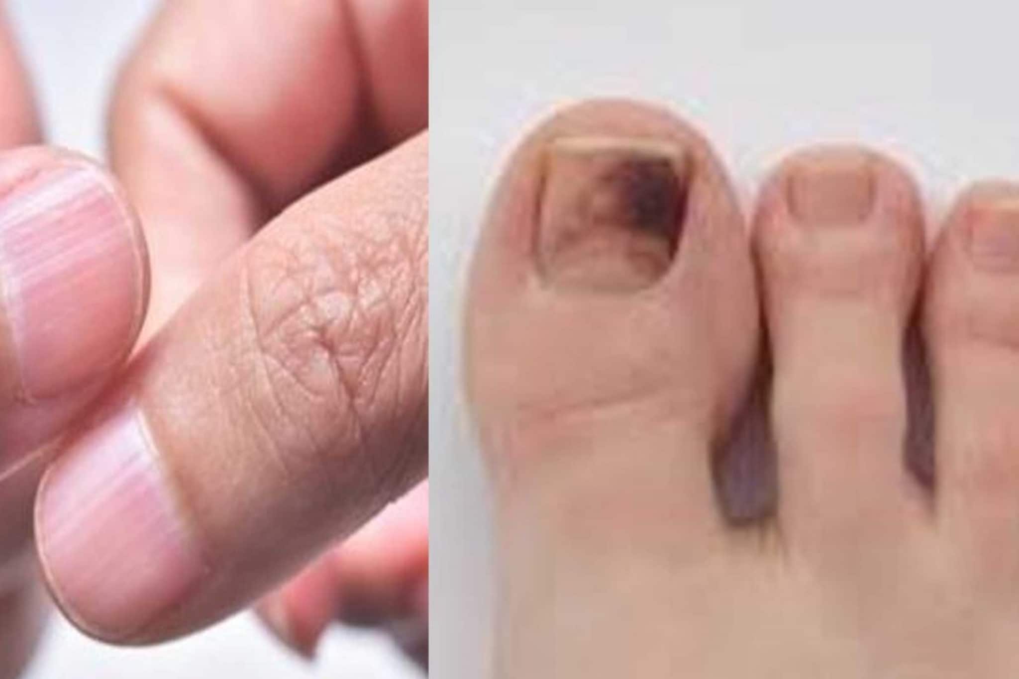 নখ বলবে শরীরে বিপদ বাসা বেঁধেছে কি না!এই লক্ষণ দেখলেই ক্যানসারের পরীক্ষা করান