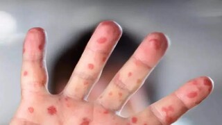 আতঙ্কের নাম মাঙ্কিপক্স আতঙ্কের নাম মাঙ্কিপক্স