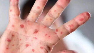 আতঙ্কের নাম মাঙ্কিপক্স আতঙ্কের নাম মাঙ্কিপক্স