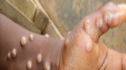 মাঙ্কিপক্স সংক্রমণ মাঙ্কিপক্স সংক্রমণ