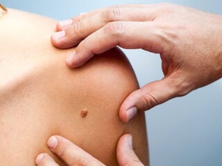 Skin Tag