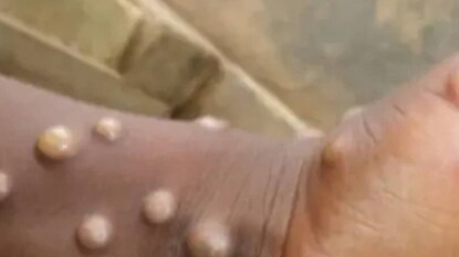 প্রাপ্তবয়স্কদের ক্ষেত্রে আদৌ উদ্বেগজনক নয়৷ কিন্তু বাচ্চাদের জন্য ভয়ানক হতে পারে কিছু ক্ষেত্রে প্রাপ্তবয়স্কদের ক্ষেত্রে আদৌ উদ্বেগজনক নয়৷ কিন্তু বাচ্চাদের জন্য ভয়ানক হতে পারে কিছু ক্ষেত্রে