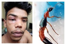 উত্তরবঙ্গের পর এবার অশোকনগরে অ্যাসিড পোকা! মুখ পুড়ল জনপ্রিয় ইউটিউবারের! ভয়াবহ উত্তরবঙ্গের পর এবার অশোকনগরে অ্যাসিড পোকা! মুখ পুড়ল জনপ্রিয় ইউটিউবারের! ভয়াবহ