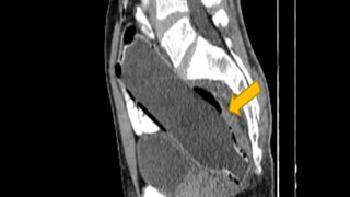 Water Bottle Inside Rectum