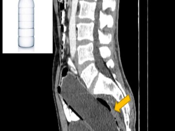Water Bottle Inside Rectum