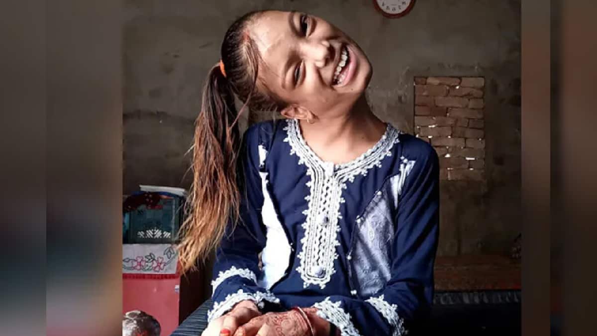 Pakistani Girl With Neck Bent At 90 Degrees Treated Successfully By Delhi Doctor For Free