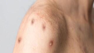 বাড়ছে মাঙ্কিপক্স আতঙ্ক, সতর্ক থাকুন 