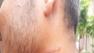 অ্যাসিড পোকার কামড়