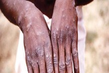 Monkeypox West Bengal: মাঙ্কিপক্স নিয়ে ভাবার সময় এসেছে, রাজ্যে নির্দেশিকা জারি স্বাস্থ্য দফতরের