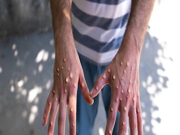 Monkeypox In India