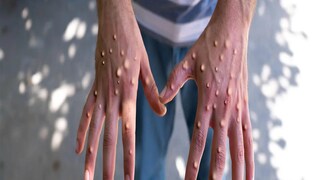 Monkeypox Guidelines