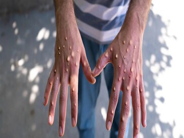 Monkeypox Guidelines