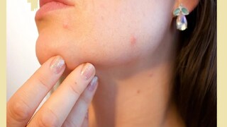 Skin Care: not all the skin infections are eczema everything you need to know