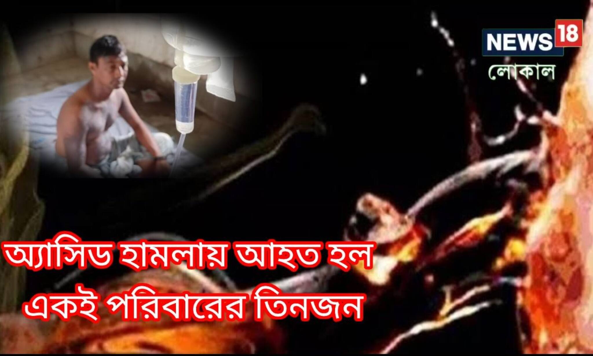 Murshidabad Acid Attack: ঘুমন্ত অবস্থায় অ্যাসিড হামলা, গুরুতর আক্রান্ত বাবা মা ও সন্তান