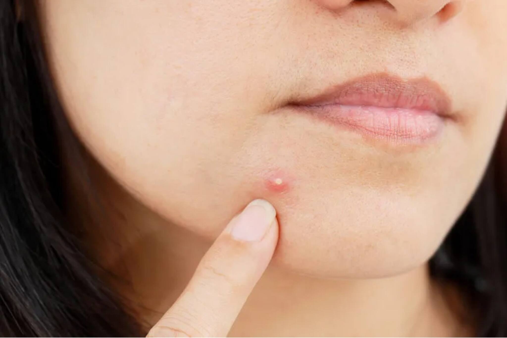 অতিরিক্ত তেল, ঘাম থেকে বাঁচতে মুখ ধোবেন কী ভাবে? জেনে নিন ব্রণ থেকে মুক্তির উপায়