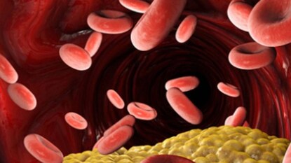 মাত্রাতিরিক্ত কোলেস্টেরলের ফলে ধমনী সরু হয়ে যায় মাত্রাতিরিক্ত কোলেস্টেরলের ফলে ধমনী সরু হয়ে যায়
