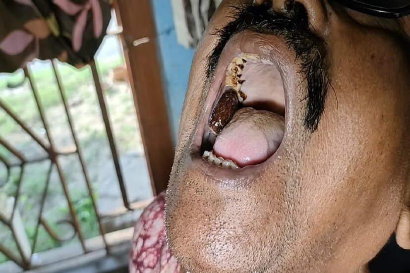 প্রথম প্রথম বীজ মুখে রাখার ফলে কেটে যেত মুখের ভেতরে অংশ। তবে এখন অভ্যাস হয়ে গিয়েছে। বাজার হাট করা থেকে বাইরে বেরোলেই, এলাকার বহু মানুষ তার মুখে রাখা এই বোনের স্মৃতি দেখতে চান প্রায় প্রতিদিনই। দাদাও বোনের স্মৃতি স্বরূপ মুখে রাখা জলপাইয়ের আঁটি দেখাতে দ্বিধাবোধ করেন না বিন্দুমাত্র। ভাইফোঁটার দিন এভাবেই বোনের স্মৃতি আগলে এক দাদা ২৬ বছর ধরে মুখে রেখে দিয়েছেন জলপাইয়ের আঁটি।