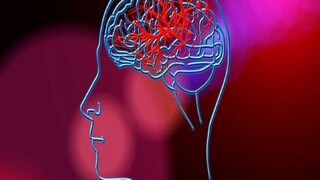 Brain Stroke: signs of a brain stroke and things one should do in this case -Photo- Representative 