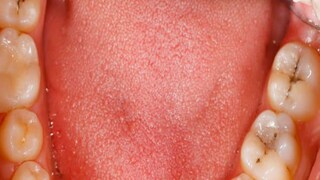 Oral Cancer Signs Oral Cancer Signs