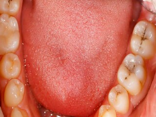 Oral Cancer Signs 