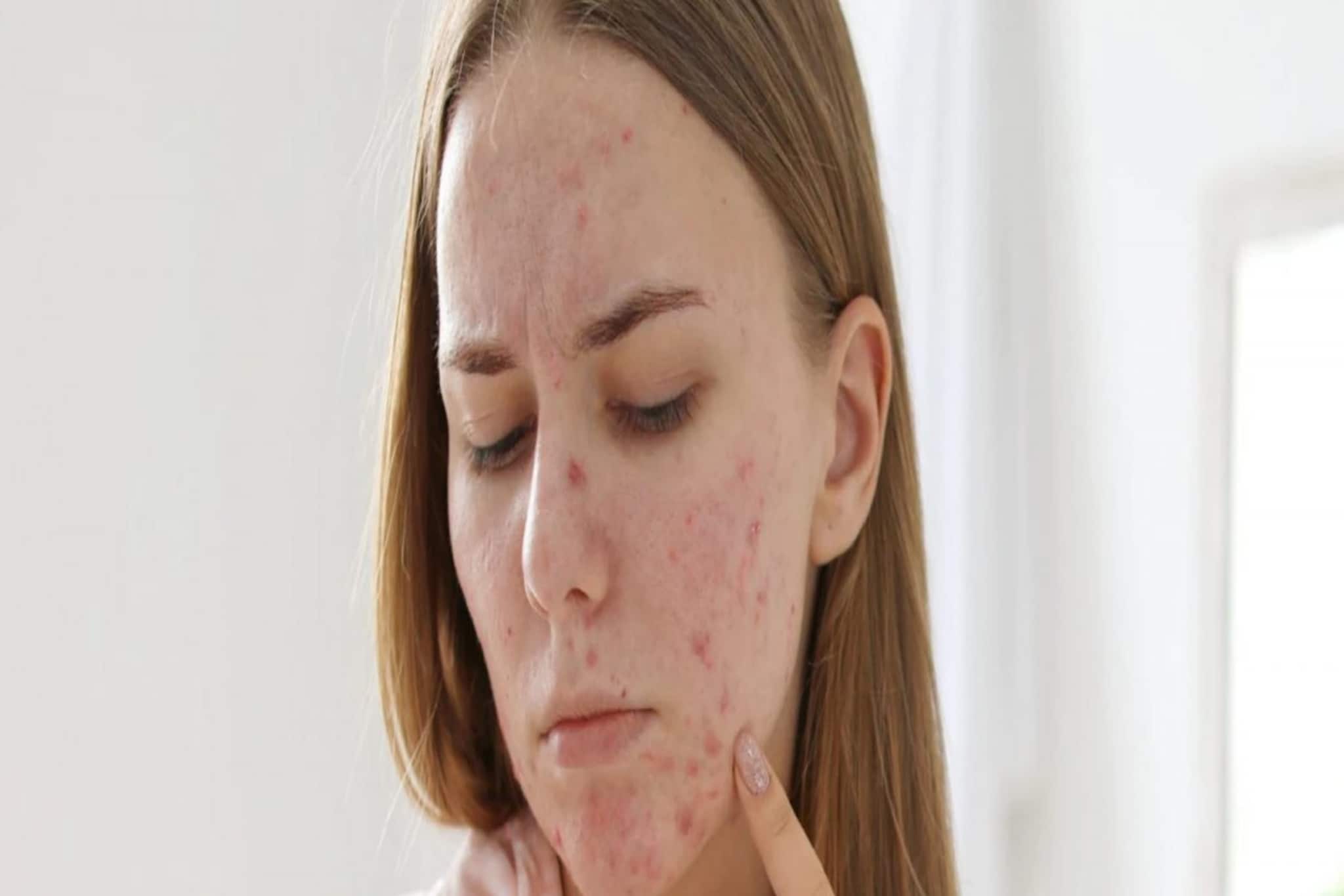 ত্বককে ব্রণমুক্ত করতে অব্যর্থ ভিটামিন ই , জেনে নিন কীভাবে ব্যবহার করবেন এই উপাদা