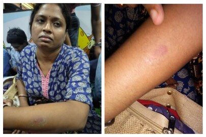 হাতের ক্ষতস্থান দেখাচ্ছেন অভিযোগকারিণী অরুণিমা পাল৷ 