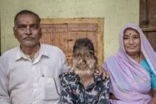 শরীরে অত্যাধিক লোম! ‘ওয়্যার উল্ফ’ সিনড্রোমে অদ্ভুত দর্শন মধ্যপ্রদেশের বালক