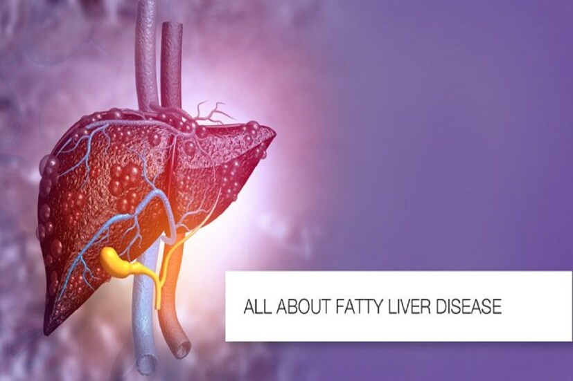 ইদানীং বহুজনই ফ্যাটি লিভার (Fatty liver)-এর সমস্যায় ভুগছেন। সাধারণত শরীরে প্রবেশ করা পাঁচ থেকে ছয় শতাংশ চর্বি শোষণ করতে পারে লিভার বা যকৃত। কিন্তু যখন এর থেকে বেশি পরিমাণ ফ্যাট লিভারে জমে, তখনই বিপত্তি! দেখা দেয় ফ্যাটি লিভারের সমস্যা। সময় মতো চিকিৎসা না করালে ভয়ঙ্কর পরিণতি, হতে পারে সিরোসিস অফ লিভারও ! বিশৈষজ্ঞরা বলছে, ফ্যাটি লিভার-এর সমস্যা দেখা দিলে এই কয়েকটা খাবার এড়িয়ে চলুন--