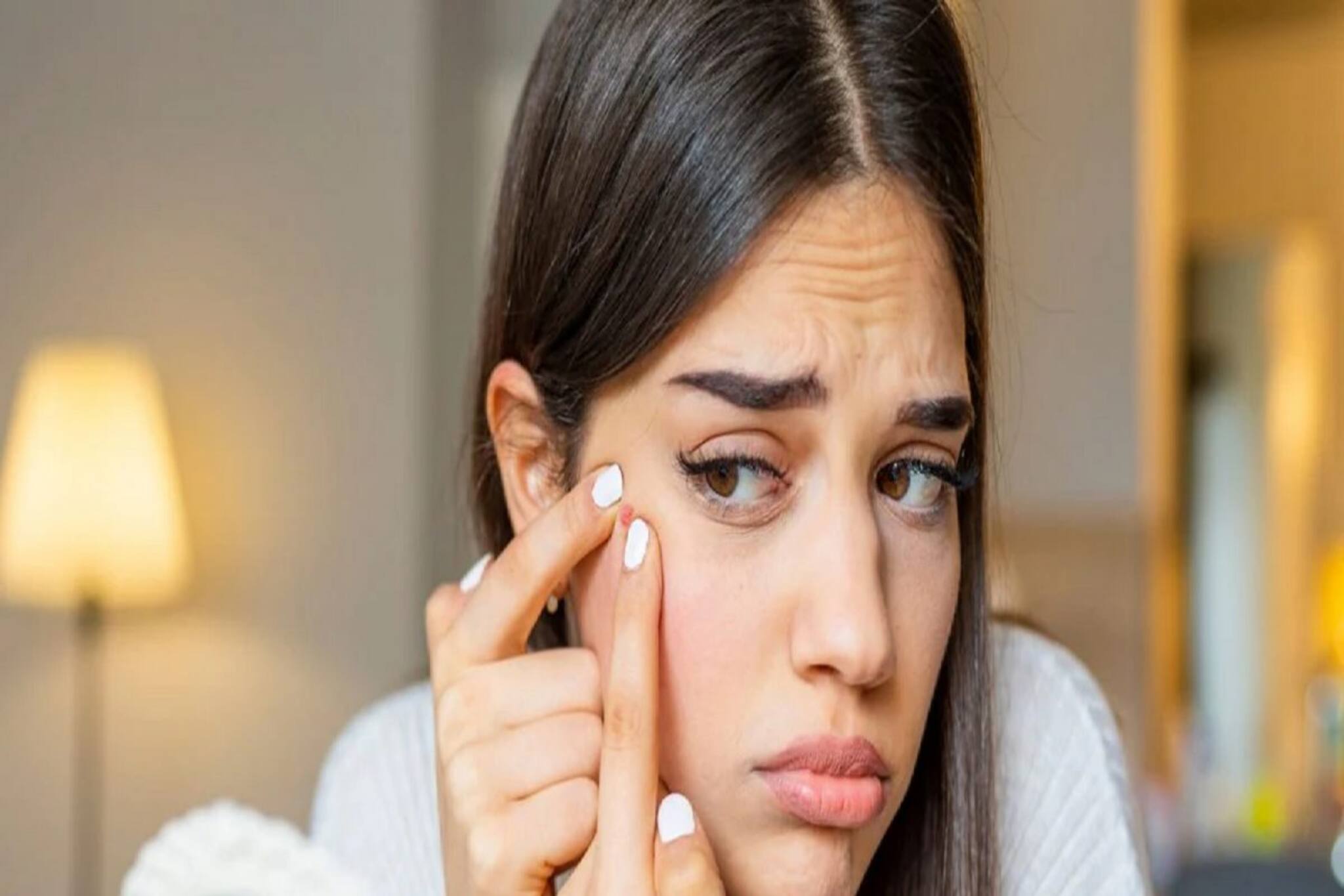 ত্বকের ব্রণর দাগ দূর করতে ব্যবহার করুন এই ৫ উপাদান, নিমেষেই মিলবে সমাধান