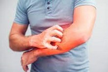 কোভিড আর্ম কী? তার লক্ষণ, কারণ ও চিকিৎসা