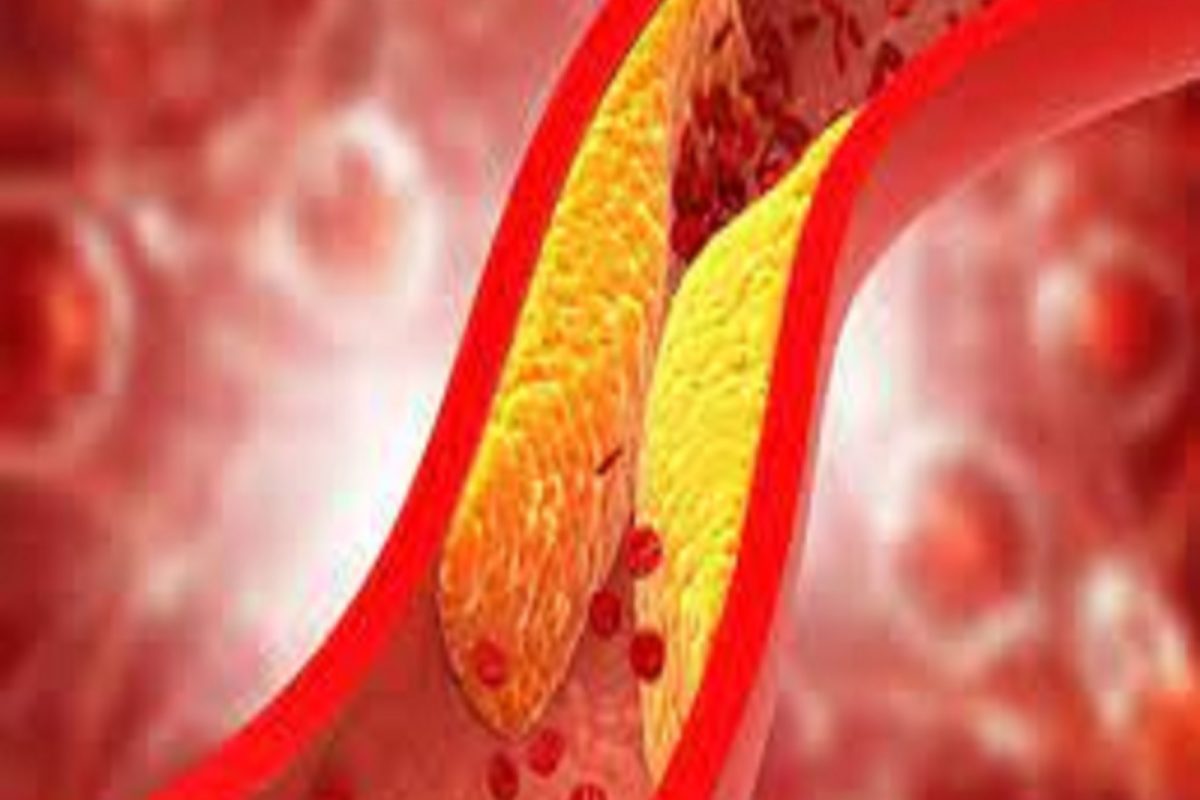High Cholesterol: খারাপ কোলেস্টেরলে Warning Sign! এড়িয়ে গেলেই মুহূর্তেই চোখের সামনে অন্ধকার, পায়ের তলার মাটি সরে যাবে!