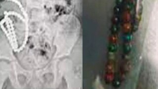 একে একে গিলেছে ৬১টা মার্বেল! ৪ বছরের মেয়ের এক্স-রে রিপোর্ট দেখে মা-বাবা অজ্ঞান