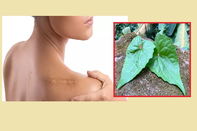 দক্ষিণ ২৪ পরগনা : হঠাৎ হাত বা পা কেটে গিয়েছে। প্রচন্ড রক্ত বেরোচ্ছে। হাতের কাছে কিছুই খুঁজে পাচ্ছে না। কি করবেন তাও ভেবে উঠতে পারছেন না। আপনার বাড়ির সামনেই এমন একটি গাছ আছে, তার পাতার রস লাগালেই রক্ত বন্ধ হয়ে যেতে পারে। সেই গাছের নাম ঢোল কলমি৷ এই পাতার রস ভীষণ কাজের৷ বেশিরভাগ ক্ষেত্রে এলাকায় বেড়া গাছ নামে পরিচিত।আপনার এলাকার বা রাস্তার ধারে বাড়ির পাশে মাঠে-ঘাটে জলাশয়ে ধারে খাল বিলের সর্বত্র চোখে পড়ে। দক্ষিণ ২৪ পরগনা : হঠাৎ হাত বা পা কেটে গিয়েছে। প্রচন্ড রক্ত বেরোচ্ছে। হাতের কাছে কিছুই খুঁজে পাচ্ছে না। কি করবেন তাও ভেবে উঠতে পারছেন না। আপনার বাড়ির সামনেই এমন একটি গাছ আছে, তার পাতার রস লাগালেই রক্ত বন্ধ হয়ে যেতে পারে। সেই গাছের নাম ঢোল কলমি৷ এই পাতার রস ভীষণ কাজের৷ বেশিরভাগ ক্ষেত্রে এলাকায় বেড়া গাছ নামে পরিচিত।আপনার এলাকার বা রাস্তার ধারে বাড়ির পাশে মাঠে-ঘাটে জলাশয়ে ধারে খাল বিলের সর্বত্র চোখে পড়ে।