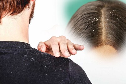 চুলময় দলা দলা খুশকি হচ্ছে? (প্রতীকী ছবি)