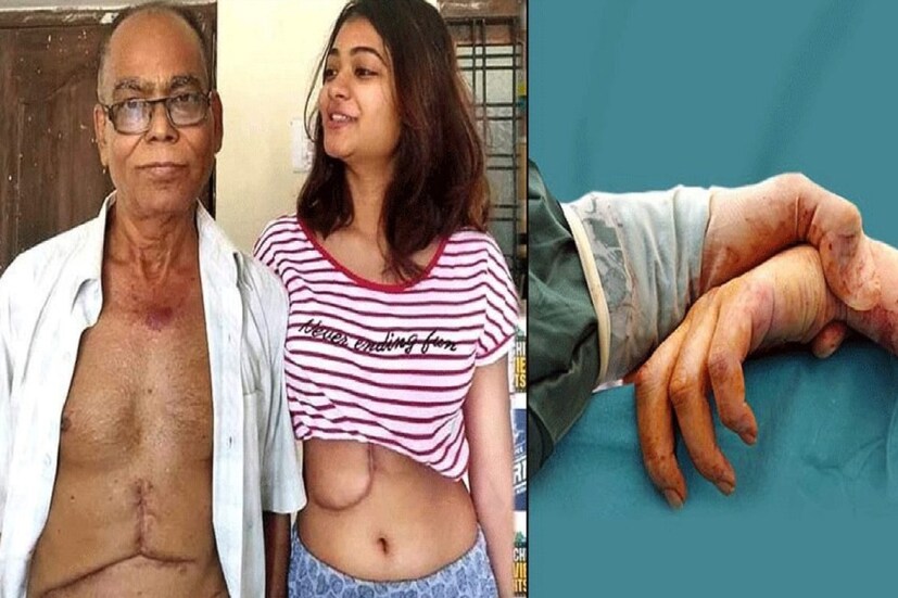 পেট অপারেশনের গভীর চিহ্নসহ বাবা-মেয়ের সেই ছবি সামাজিক যোগাযোগ মাধ্যমে ভাইরাল হয়ে যায়। বাবার জন্য ১৯ বছর বয়সী তরুণীর দুর্দান্ত সাহস আর ভালোবাসার প্রশংসা করছেন সবাই। কেউ কেউ জানাচ্ছেন, এর থেকেই বোঝা যায় কন্যা সন্তান ফেলনা নয়।