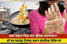 রান্না করতে গিয়ে হাত পুড়িয়ে ফেলেছেন? এই সব ঘরোয়া উপায়ে করুন প্রাথমিক চিকিৎসা