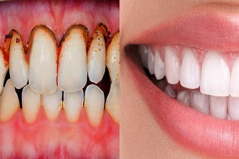 দাঁত সুন্দর হওয়ার থেকেও জরুরি পরিস্কার থাকা। কালো ছোপ থাকলেই সব শেষ। যতই হাসি মিষ্টি হোক না কেন দেখতে মোটেও ভাল লাগে না। এতে আপনার আত্মবিশ্বাসও কমতে থাকে। তবে দাঁত পরিস্কার করা মানে শুধুই কী দাঁতের ডাক্তারের কাছে যাওয়া? মোটেই না রয়েছে সহজ কিছু উপায়। যা ঝট করে সাফ করবে দাঁতের কালো ছোপ বা হলদেটে ভাব! photo source collected দাঁত সুন্দর হওয়ার থেকেও জরুরি পরিস্কার থাকা। কালো ছোপ থাকলেই সব শেষ। যতই হাসি মিষ্টি হোক না কেন দেখতে মোটেও ভাল লাগে না। এতে আপনার আত্মবিশ্বাসও কমতে থাকে। তবে দাঁত পরিস্কার করা মানে শুধুই কী দাঁতের ডাক্তারের কাছে যাওয়া? মোটেই না রয়েছে সহজ কিছু উপায়। যা ঝট করে সাফ করবে দাঁতের কালো ছোপ বা হলদেটে ভাব! photo source collected