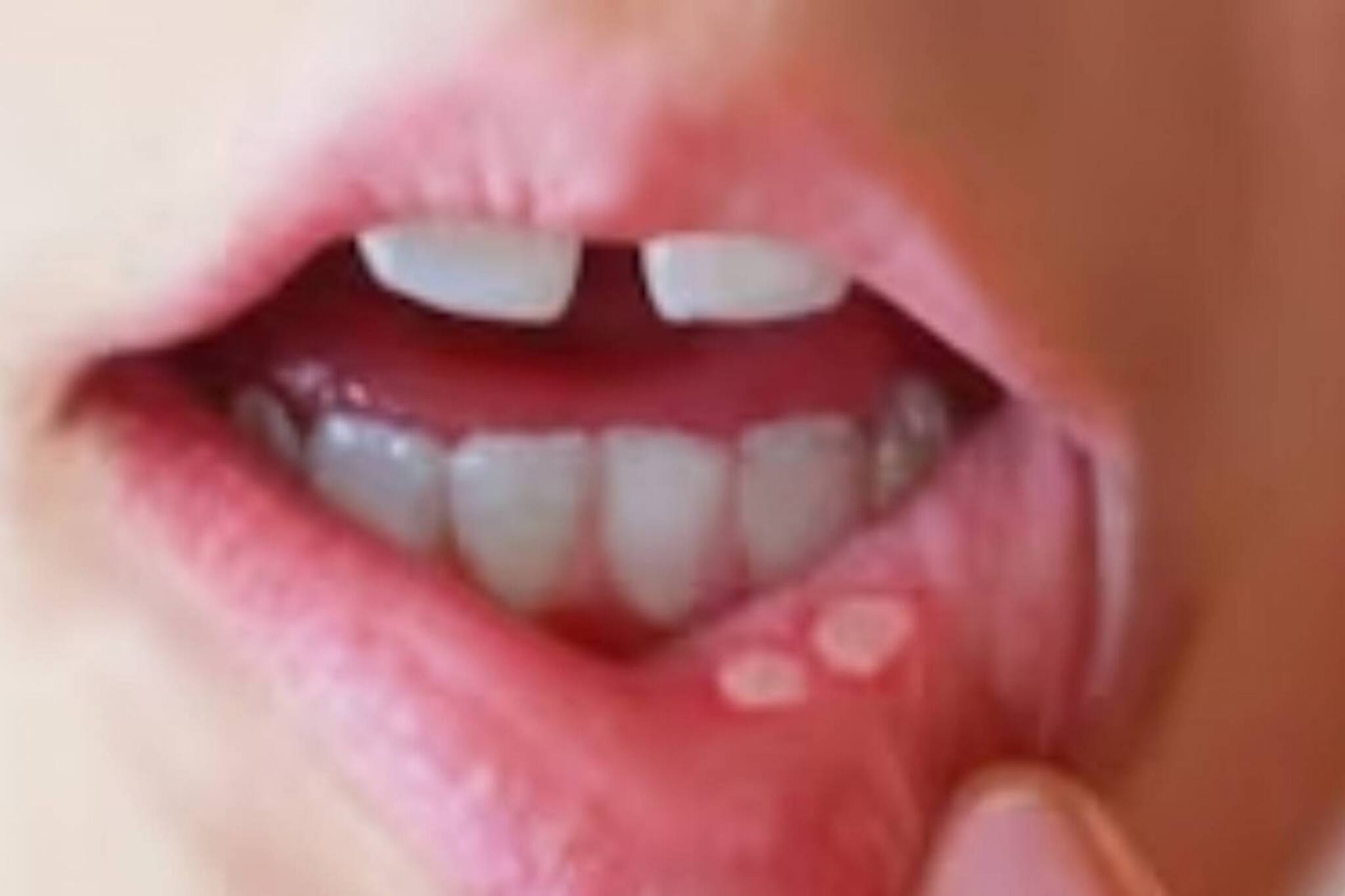 অসহ্য যন্ত্রণা! মাউথ আলসার ঘন ঘন কেন হয়, জানুন কারণ