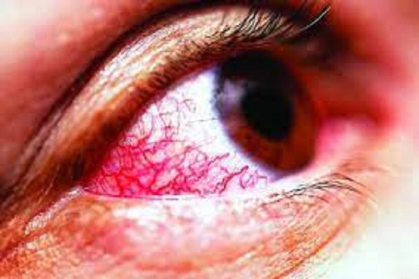 (Ischemic optic neuropathy) চোখ ও মস্তিষ্কের সংযোগকারী স্নায়ু অত্যন্ত খারাপ হয়ে যায় ৷ হাই ব্লাডপ্রেশারের ফলে চোখের স্নায়ুগুলিতে রক্তপ্রবাহ ক্ষতিগ্রহস্ত হতে পারে ৷ প্রতীকী ছবি ৷