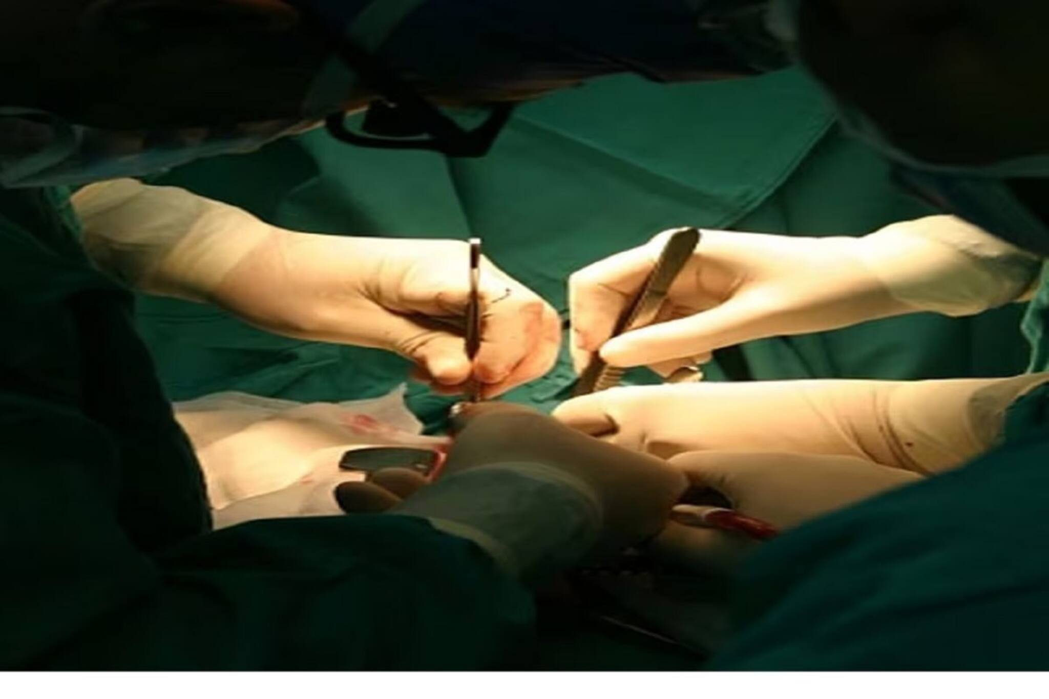 ‘চোখের আলো’ কর্মসূচি রূপায়ণে ঢিলেঢালা মনোভাব,ছানি অপারেশনের গতি বাড়ানোর চেষ্টা