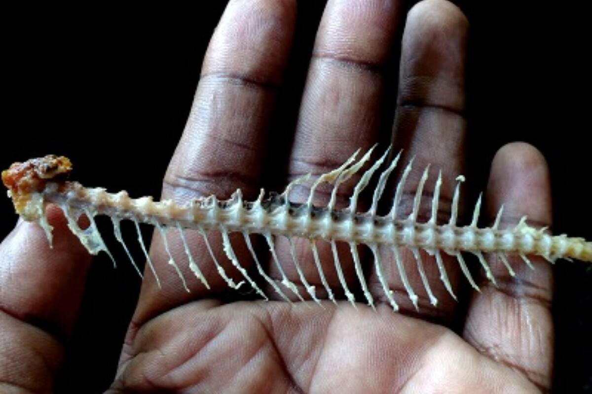 Fish Bone Stuck in Throat গলায় মাছের কাঁটা বিঁধে অসহ্য যন্ত্রণা! সহজে