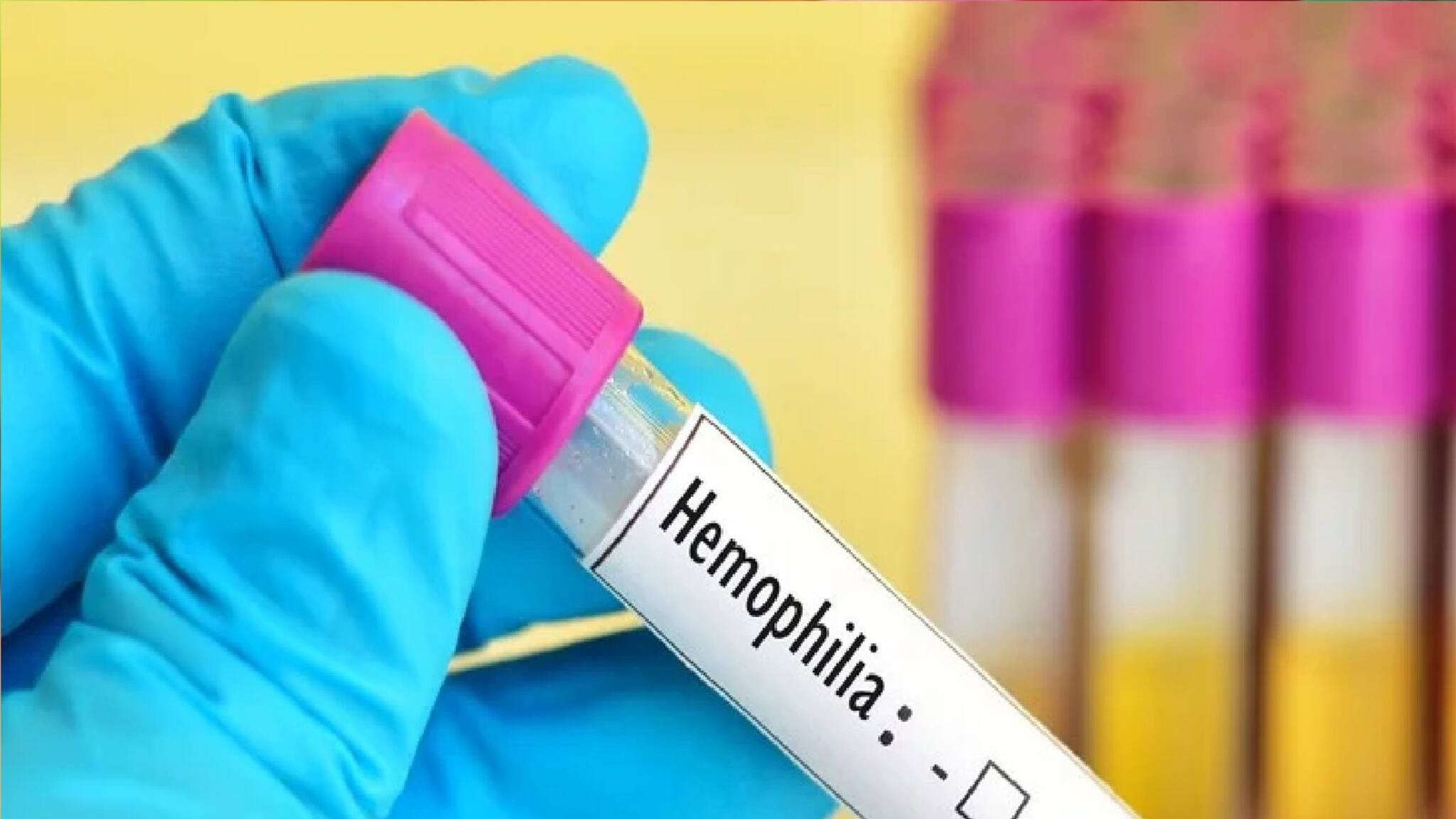 হিমোফিলিয়া! এই রোগ প্রতিরোধে সচেতনতাই একমাত্র ভরসা, বলছেন বিশেষজ্ঞরা